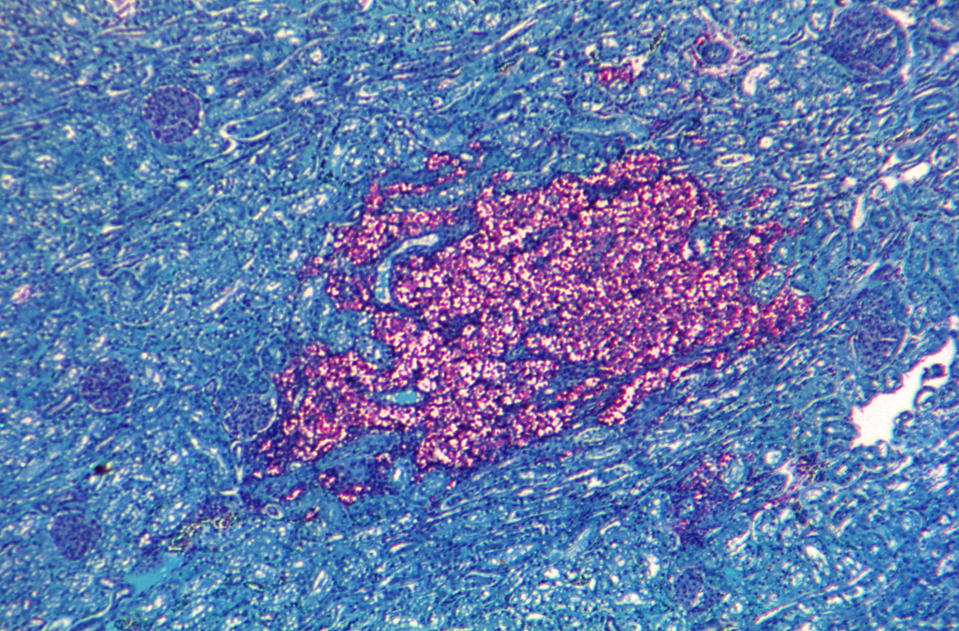 Cryptococcus_500X_Tejido riñón teñido con mucicarmina_se observan células del hongo coloración rojiza Fuente: Public Health Image Library CDC