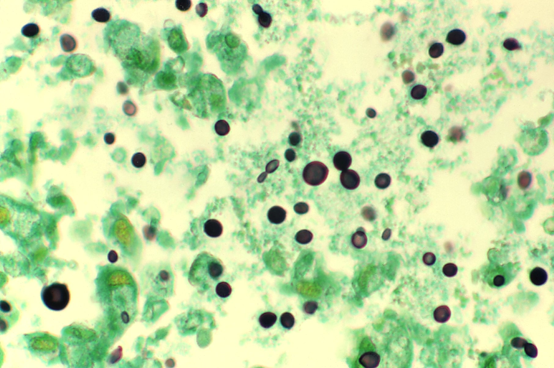 Cryptococcus_tejido de pulmón de paciente con sida teñido con plata metenamina Fuente: Public Health Image Library CDC