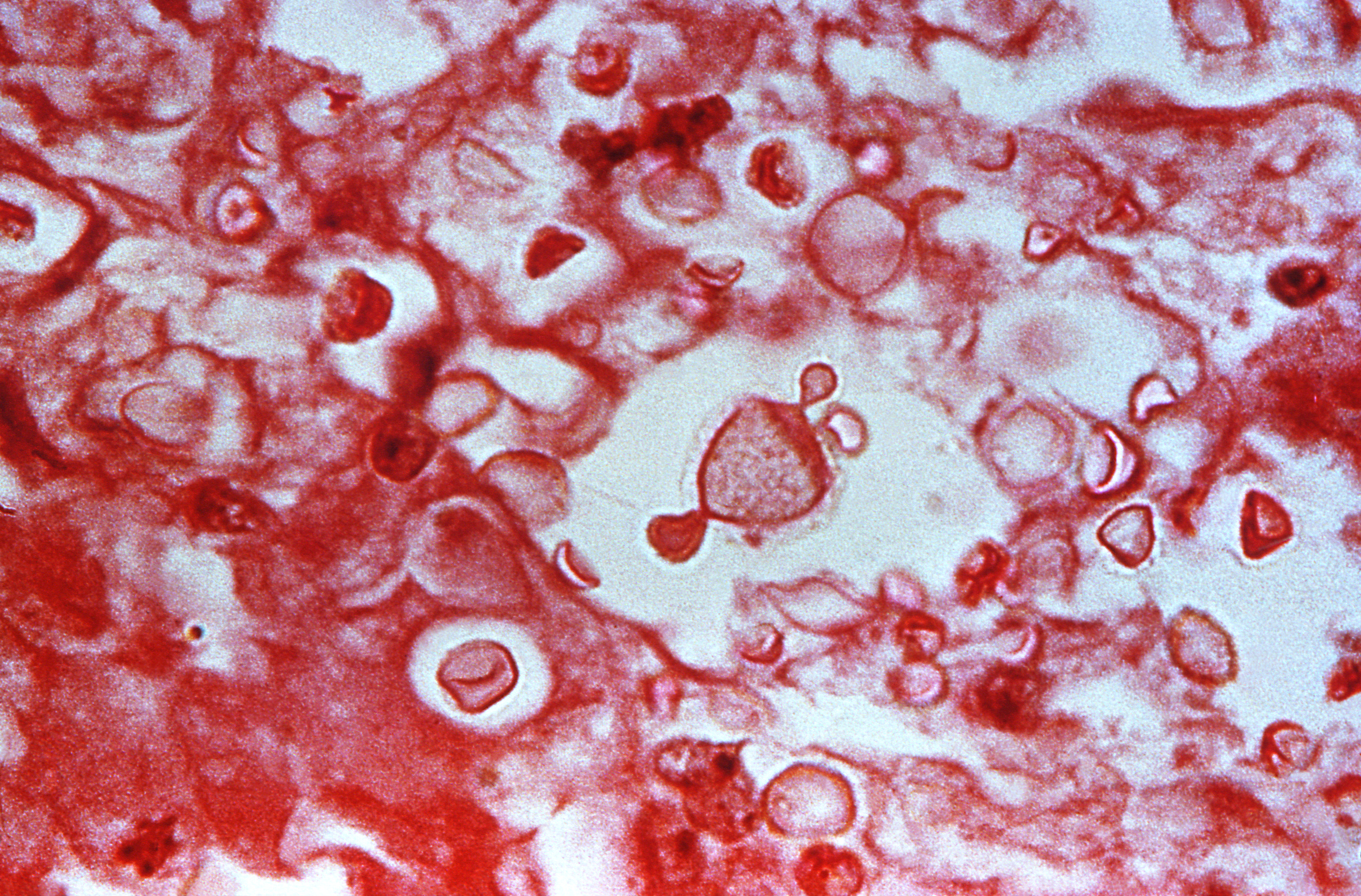 Cryptococcus_tejido de pulmón teñido con Hematoxilina Eosina Fuente: Public Health Image Library CDC